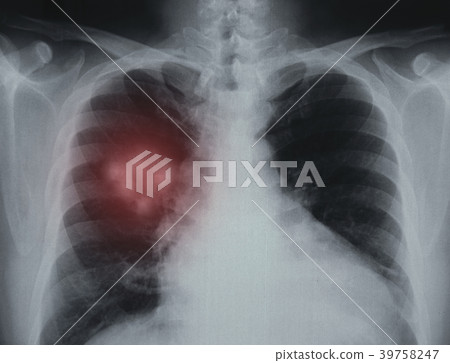 lung disease 39758247