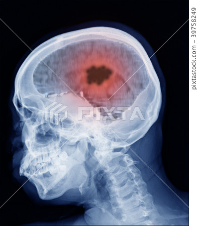 brain cancer 39758249
