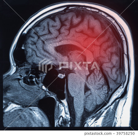 brain intracerebral hemorrhage 39758250