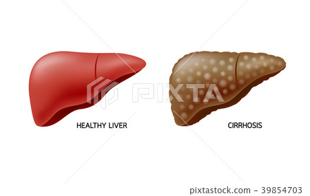 Comparison of healthy liver and cirrhosis. Comparison of healthy liver and cirrhosis. 39854703