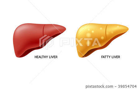 Comparison of healthy liver and fatty live. Comparison of healthy liver and fatty live. 39854704