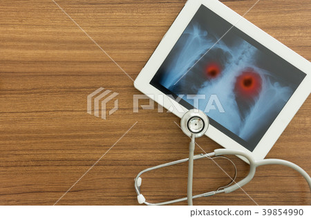 lung cancer x ray lung cancer x ray 39854990