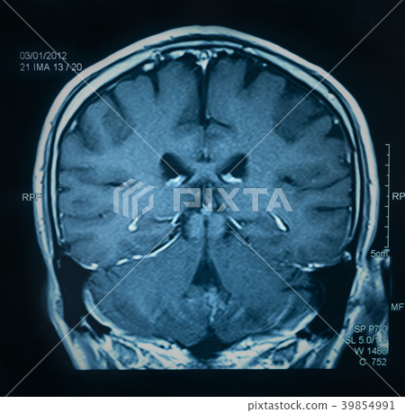mri scan brain 39854991