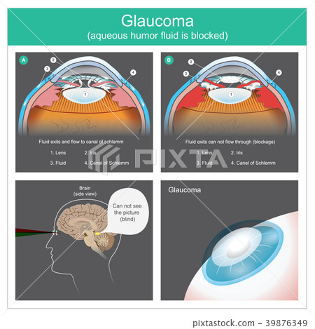 Glaucoma. Aqueous humour fluid exits.... Glaucoma. Aqueous humour fluid exits.... 39876349