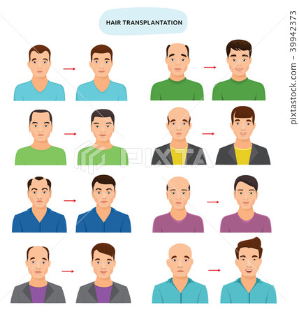 Hair transplant vector hairy transplantation after hairloss and baldness for bald man illustration 39942373