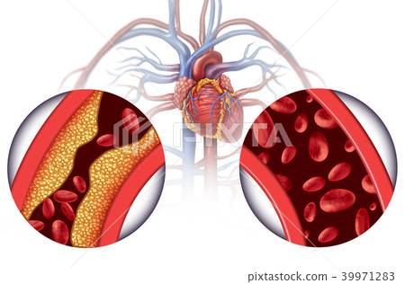 Chelation Therapy 39971283