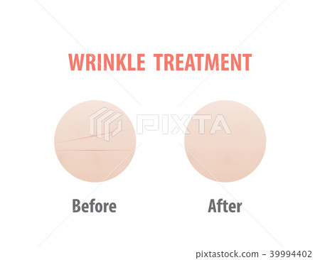 Wrinkle treatment comparison illustration vector Wrinkle treatment comparison illustration vector 39994402