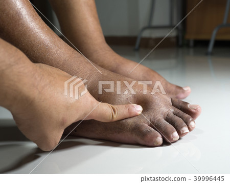 The feet of people with diabetes, dull and swollen The feet of people with diabetes, dull and swollen 39996445