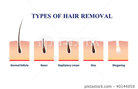 Types Of Hair Removal Illustration Stock Illustration 40144858