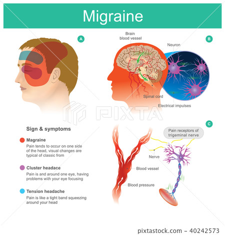 Migraine. Headache pain Migraine. Headache pain 40242573