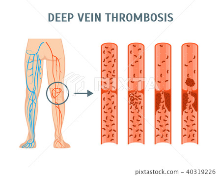 Cartoon Deep Vein Thrombosis Infographics Card Poster. Vector 40319226