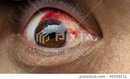 Blood in the eye from a subconjunctival hemorrhage Blood in the eye from a subconjunctival hemorrhage 40399552