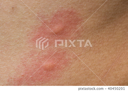 Scratch Allergic skin from mosquito or insect bite Scratch Allergic skin from mosquito or insect bite 40450201
