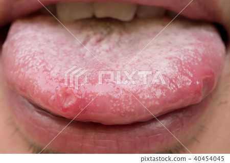tongue with ulcers of adult man tongue with ulcers of adult man 40454045