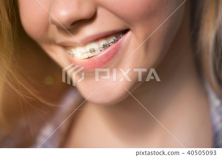 Portrait of teen girl showing dental braces. Portrait of teen girl showing dental braces. 40505093
