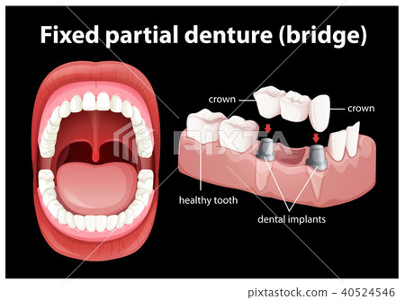 Medical Vector of Fixed Partial Denture Medical Vector of Fixed Partial Denture 40524546