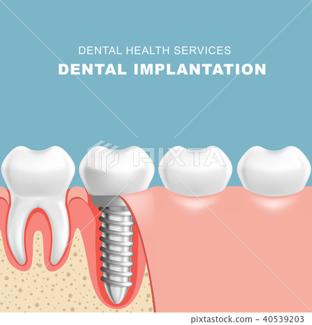 Gum section with dental implantat - row of teeth 40539203