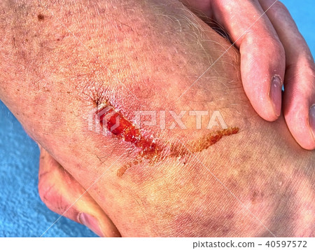 Detail of scab on leg after accident.  Wet blood 40597572