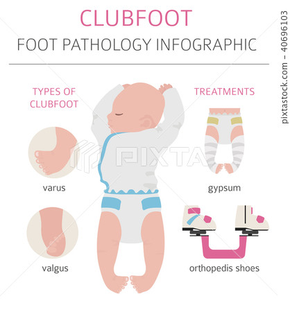 Foot Deformation Medical Infographic Clubfoot Stock Illustration