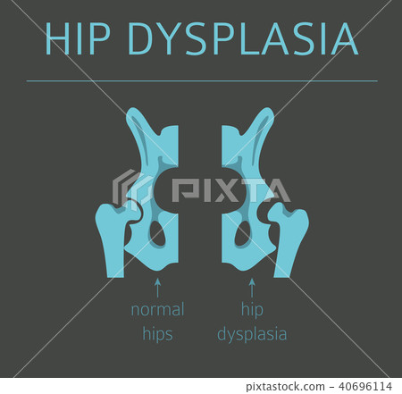 Medical infographic. Hip dysplasia 40696114