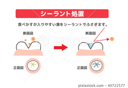 Description of sealant treatment Cross section of teeth 40722577