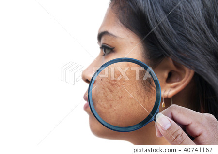 acne on skin face women 40741162