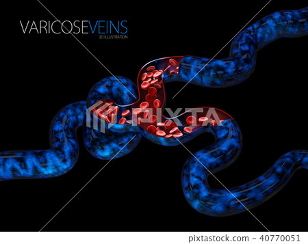 Varicose veins close up. 40770051