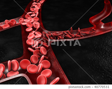 Anemia, sickle cell and normal red blood cell 40770531