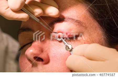 Chalazion during eye examination and operation 40774587