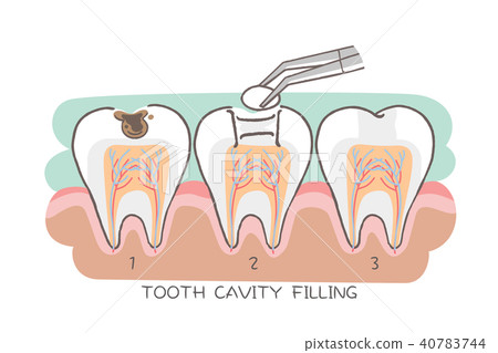 tooth cavity filling tooth cavity filling 40783744