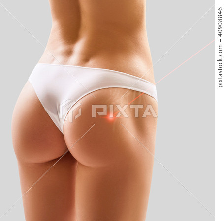 Female buttocks with laser ray removes stretchmarks. 40908846