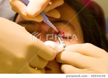 Healthcare concept - Chalazion during eye examination and operat 40934249