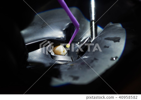 Closeup of fixing a tooth using a black rubber dam and dental instruments 40958582