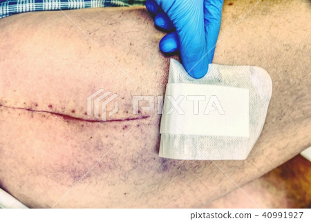 Replacing of hip joint for hip endoprosthesis. 40991927