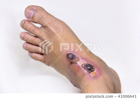 Closeup of blisters scab on man foot. 41006641