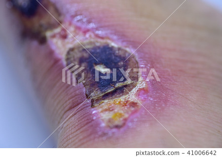 Closeup of blisters scab on man foot. Closeup of blisters scab on man foot. 41006642