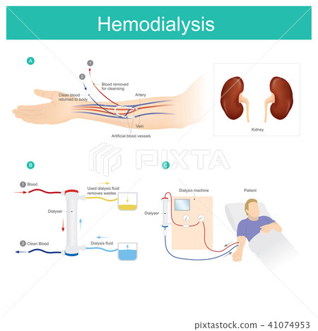 Hemodialysis. Patient blood is put through  41074953