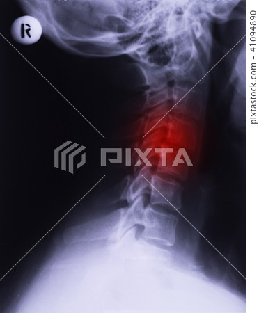 X-ray of neck 41094890