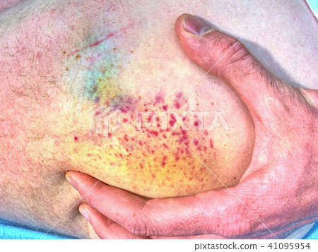 Large colorful bruise on body. Painful hurt place 41095954