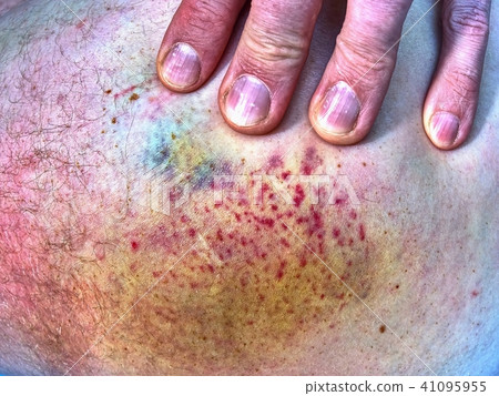 Big bruise on the body. Painful work accident. Big bruise on the body. Painful work accident. 41095955