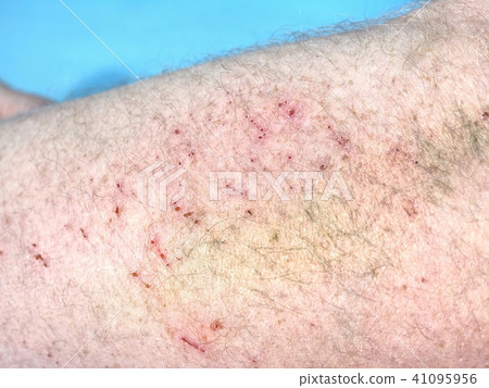 Detail of hematoma, cracked veins below surface Detail of hematoma, cracked veins below surface 41095956