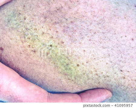 Hand embracing injured leg with painful hematoma 41095957