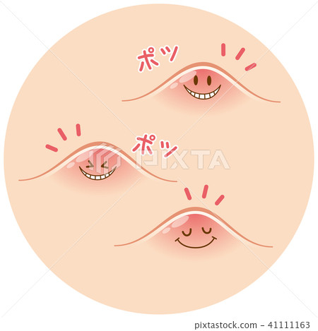 痤瘡粉刺 41111163