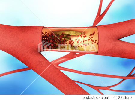 Cross section of a narrowing blood vessel 41223639