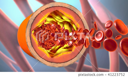3d illustration of a precipitated and narrowing bl 41223752