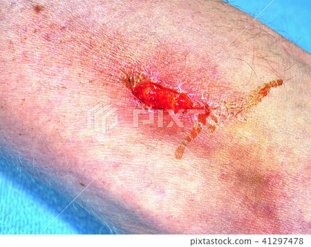 Embracing injured leg with painful place. Embracing injured leg with painful place. 41297478