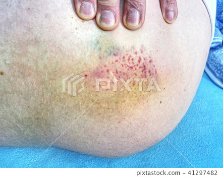 Big bruise on the body. Painful work accident. Big bruise on the body. Painful work accident. 41297482