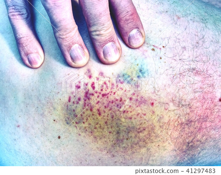 Fresh bruise on skin.  Painful green purple bruise 41297483