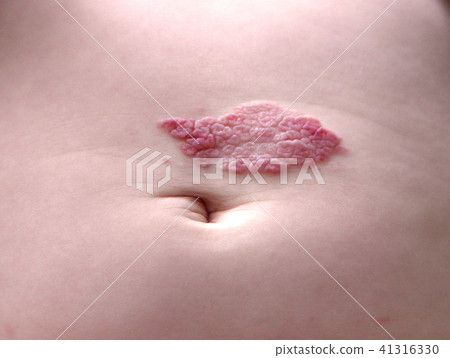 Capillary hemangioma regression. Red birthmark on the baby's belly after treatment Capillary hemangioma regression. Red birthmark on the baby's belly after treatment 41316330