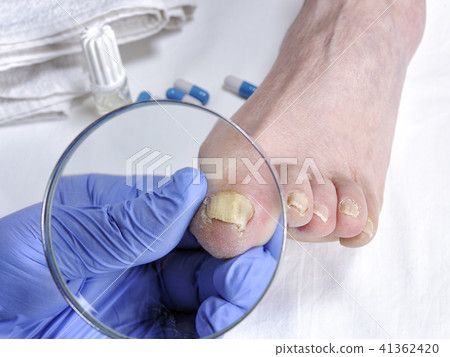Onychomycosis, nail disease caused by fungi 41362420